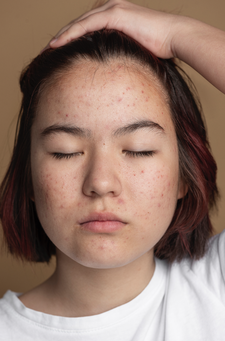 Acne Scars and Skin Discoloration