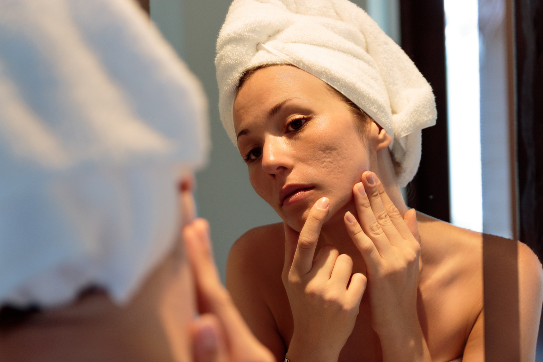 How can Silicone Help Treat your Acne Scars
