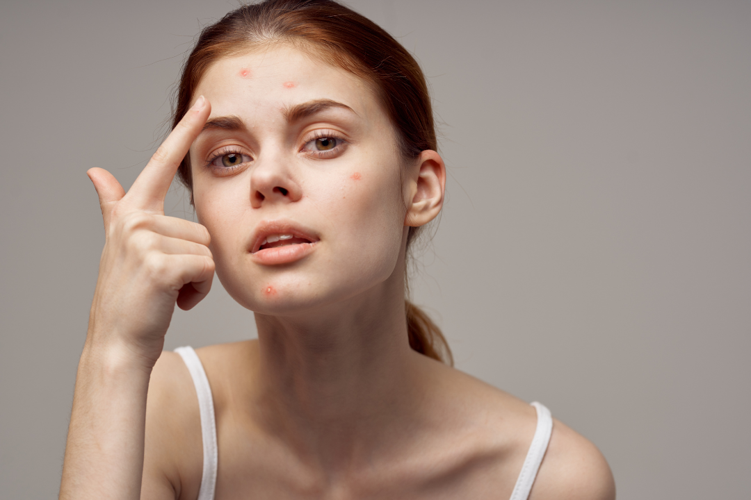 Dealing with Acne Scars and its Impact on my Mental Health