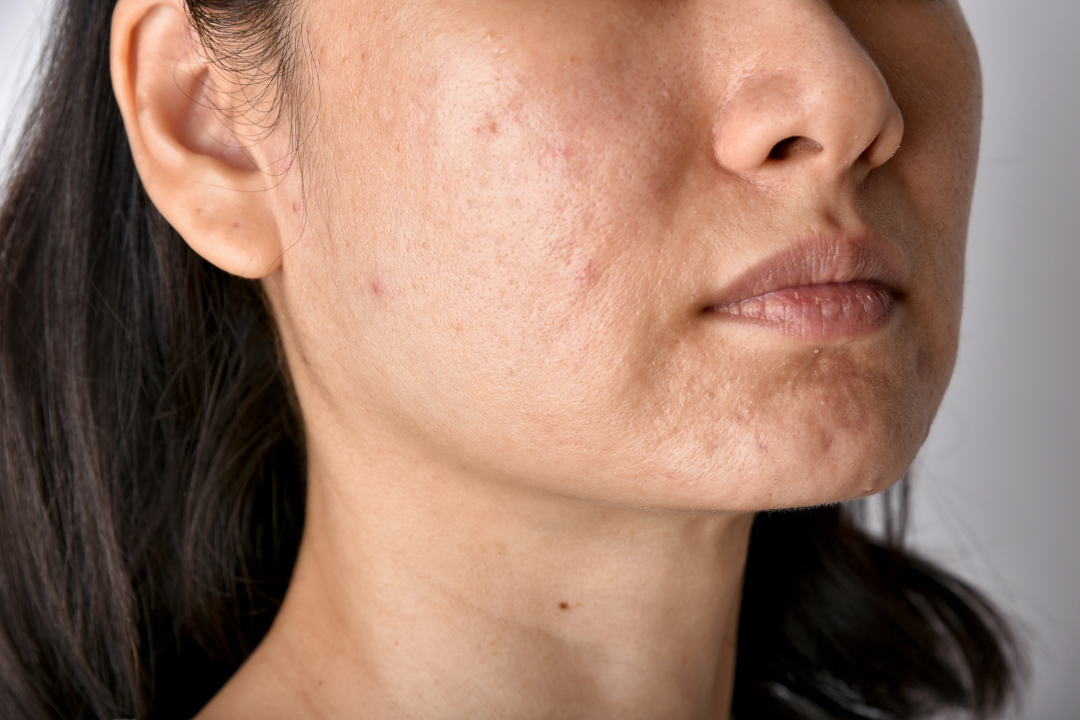 What are Acne Scar Patches?