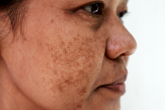 woman with dark spots on her face
