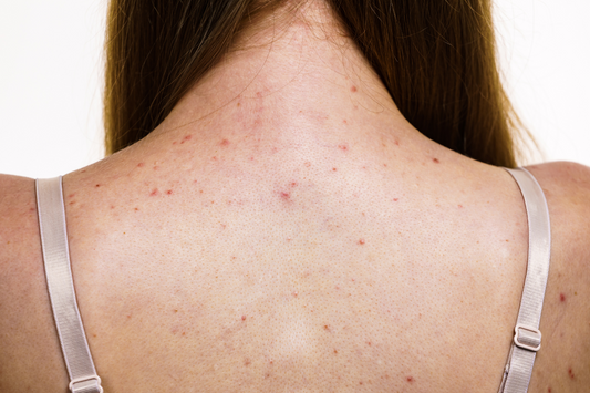 Dealing with Pimple Popping on Your Back?