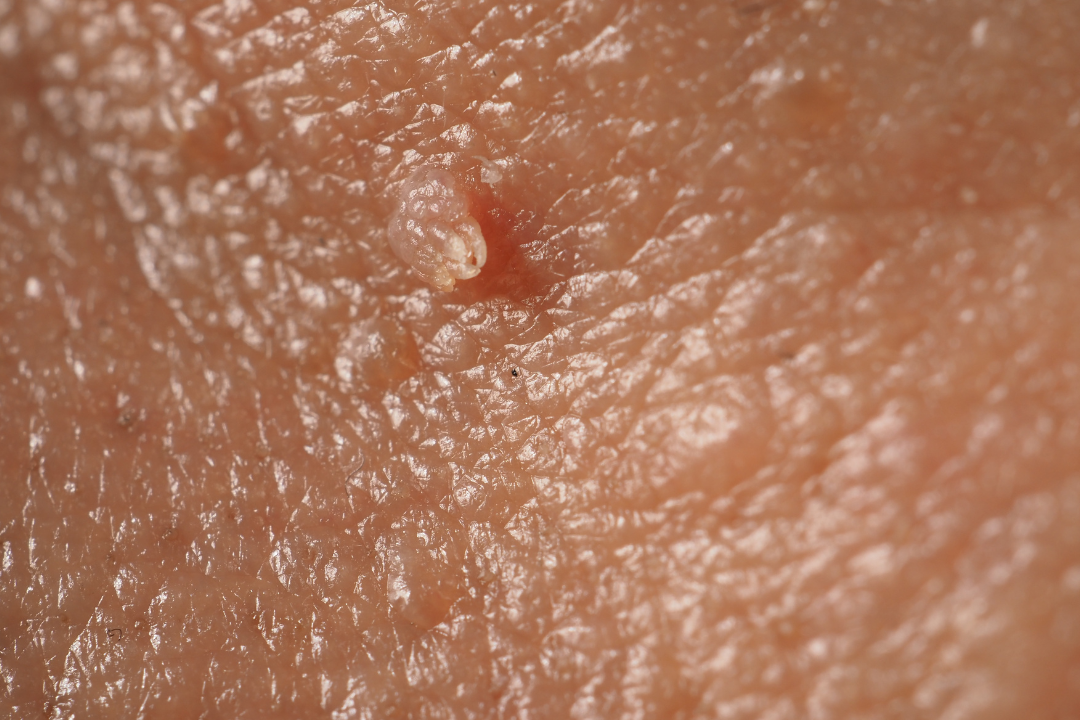 Decoding Ingrown Hair vs. Wart: Your Guide to Clarity and Relief with Fazit's Ingrown Hair Patch