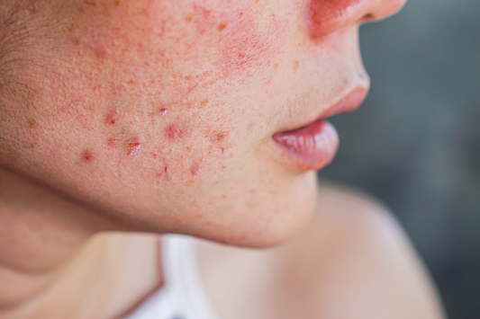 How to Use Silicone fo Acne Scars