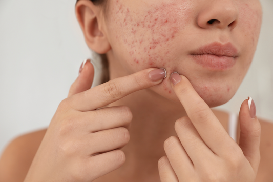 Learn more about Acne Scars and Treatment Methods