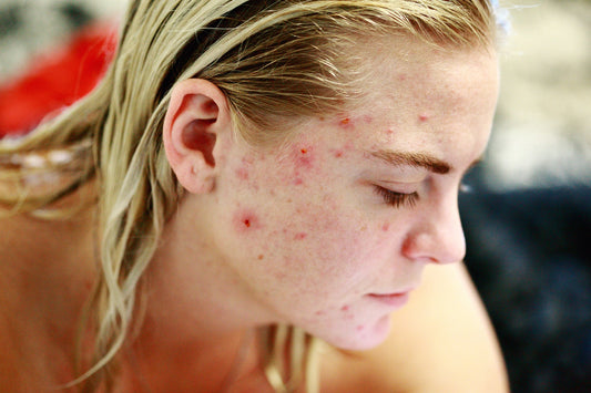 Girl with Acne Prone Skin